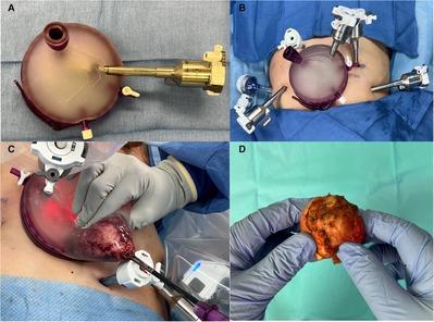 Robot-assisted radical prostatectomy: Advancements in surgical technique and perioperative care
